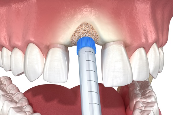 A Bone Graft May Be Needed Before Getting Dental Implants