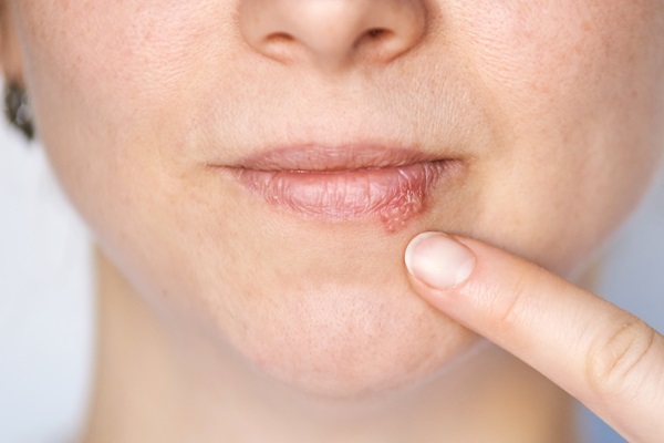 Common Questions About Cold Sore Treatment