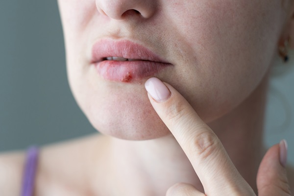 When To Visit A Dentist For Cold Sore Treatment