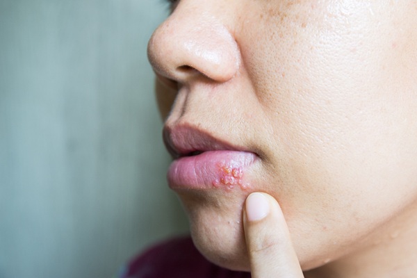 Effective Cold Sore Treatment Options Recommended By A Dentist
