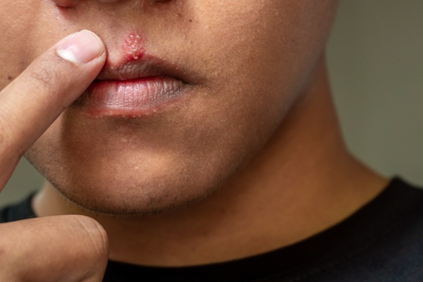 Managing Outbreaks: Options For Cold Sore Treatment