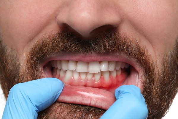 Gum Disease Treatment Options: From Deep Cleanings To Ongoing Maintenance
