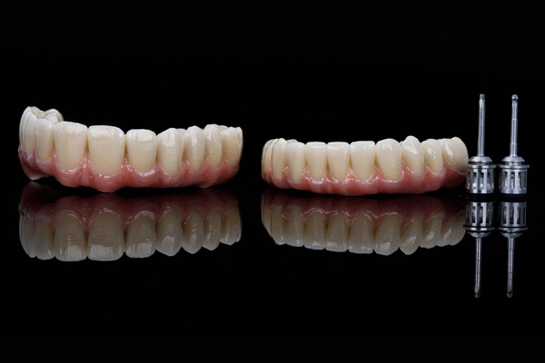 Common Questions About Implant Supported Dentures