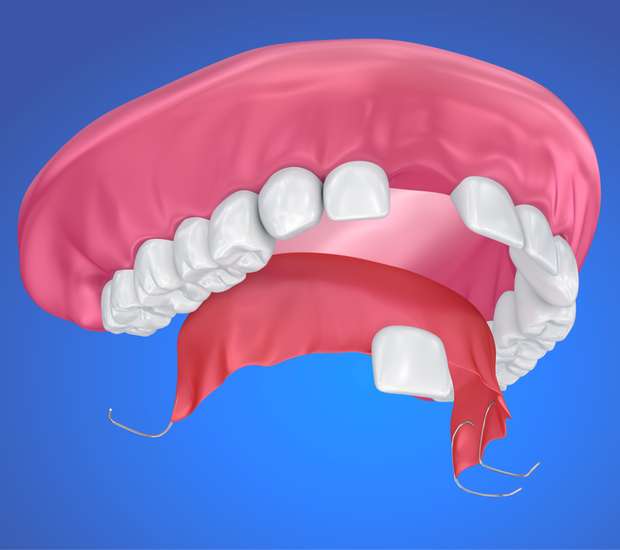 Oakland Partial Denture for One Missing Tooth