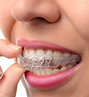 Clear Aligners - Almost Invisible Braces Oakland, CA